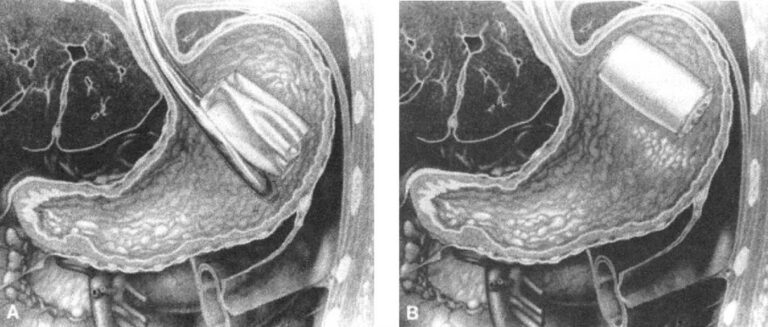 İntragastrik (mide içi) balon ne demektir? 2